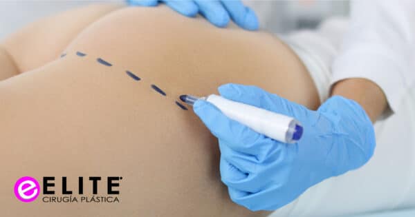 ELITE BLOG Lipoescultura a gluteos
