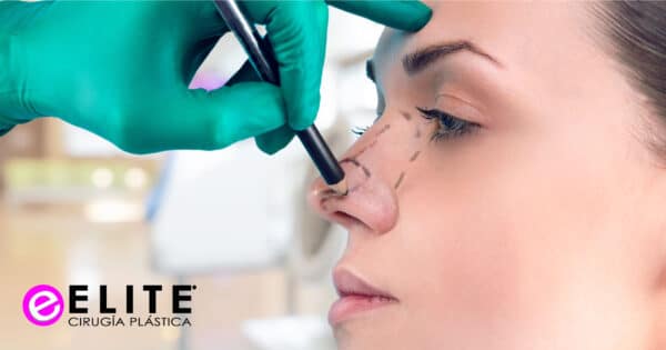 ELITE BLOG Rinoplastia estructural